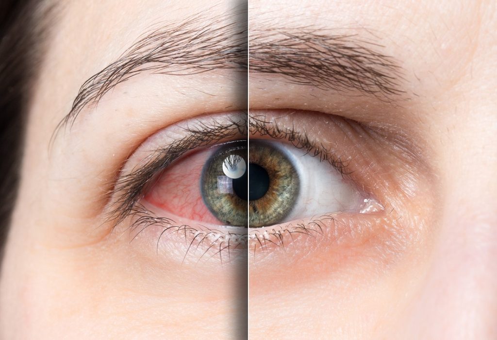 Zinc deficiency