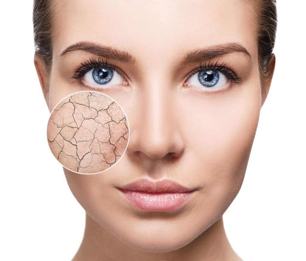 Dryness and skin irritation - Omega 3